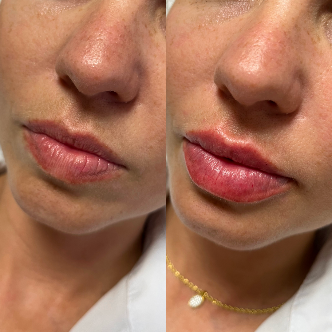 1 Hidratação com Skinbooster